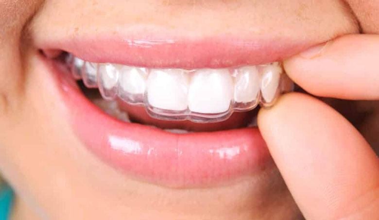 Invisalign folije za ispravljanje zuba​